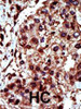 Formalin-fixed and paraffin-embedded human cancer tissue reacted with the primary antibody, which was peroxidase-conjugated to the secondary antibody, followed by AEC staining. BC = breast carcinoma; HC = hepatocarcinoma.