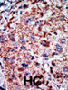 Formalin-fixed and paraffin-embedded human cancer tissue reacted with the primary antibody, which was peroxidase-conjugated to the secondary antibody, followed by AEC staining. BC = breast carcinoma; HC = hepatocarcinoma.