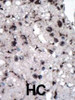 Formalin-fixed and paraffin-embedded human cancer tissue reacted with the primary antibody, which was peroxidase-conjugated to the secondary antibody, followed by DAB staining. BC = breast carcinoma; HC = hepatocarcinoma.