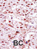 Formalin-fixed and paraffin-embedded human cancer tissue reacted with the primary antibody, which was peroxidase-conjugated to the secondary antibody, followed by DAB staining. BC = breast carcinoma