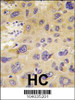 Formalin-fixed and paraffin-embedded human hepatocarcinoma tissue reacted with PFKFB1 antibody (N-term) , which was peroxidase-conjugated to the secondary antibody, followed by DAB staining.