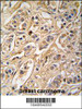 Formalin-fixed and paraffin-embedded human breast carcinoma tissue reacted with 14-3-3 protein zeta/delta antibody, which was peroxidase-conjugated to the secondary antibody, followed by DAB staining.
