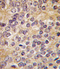 Formalin-fixed and paraffin-embedded human prostata carcinoma tissue reacted with PLAU antibody (C-term ) , which was peroxidase-conjugated to the secondary antibody, followed by DAB staining.