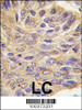 Formalin-fixed and paraffin-embedded human lung carcinoma tissue reacted with MEG2 antibody, which was peroxidase-conjugated to the secondary antibody, followed by DAB staining.