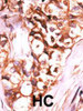 Formalin-fixed and paraffin-embedded human cancer tissue reacted with the primary antibody, which was peroxidase-conjugated to the secondary antibody, followed by AEC staining. BC = breast carcinoma; HC = hepatocarcinoma.