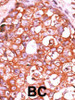 Formalin-fixed and paraffin-embedded human cancer tissue reacted with the primary antibody, which was peroxidase-conjugated to the secondary antibody, followed by AEC staining. BC = breast carcinoma; HC = hepatocarcinoma.