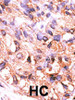 Formalin-fixed and paraffin-embedded human cancer tissue reacted with the primary antibody, which was peroxidase-conjugated to the secondary antibody, followed by AEC staining. BC = breast carcinoma; HC = hepatocarcinoma.