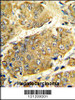 Formalin-fixed and paraffin-embedded human hepatocarcinoma reacted with LTA Antibody, which was peroxidase-conjugated to the secondary antibody, followed by DAB staining.