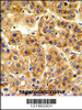 Formalin-fixed and paraffin-embedded human hepatocarcinoma reacted with SIL1 Antibody, which was peroxidase-conjugated to the secondary antibody, followed by DAB staining.