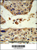 Formalin-fixed and paraffin-embedded human hepatocarcinoma reacted with HPD Antibody, which was peroxidase-conjugated to the secondary antibody, followed by DAB staining.