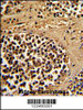 Formalin-fixed and paraffin-embedded human kidney carcinoma reacted with ESRRA Antibody, which was peroxidase-conjugated to the secondary antibody, followed by DAB staining.