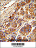 Formalin-fixed and paraffin-embedded human hepatocarcinoma with KLC1 Antibody, which was peroxidase-conjugated to the secondary antibody, followed by DAB staining.