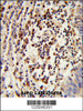 Formalin-fixed and paraffin-embedded human lung carcinoma reacted with MOSC2 Antibody, which was peroxidase-conjugated to the secondary antibody, followed by DAB staining.