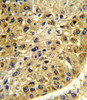 Formalin-fixed and paraffin-embedded human hepatocarcinoma reacted with DCT Antibody (N-term) , which was peroxidase-conjugated to the secondary antibody, followed by DAB staining.