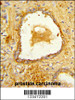 Formalin-fixed and paraffin-embedded human prostate carcinoma reacted with DAB2 Antibody, which was peroxidase-conjugated to the secondary antibody, followed by DAB staining.