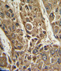Formalin-fixed and paraffin-embedded human hepatocarcinoma with MTTP Antibody, which was peroxidase-conjugated to the secondary antibody, followed by DAB staining.