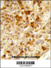 Formalin-fixed and paraffin-embedded human hepatocarcinoma reacted with PXMP3 Antibody, which was peroxidase-conjugated to the secondary antibody, followed by DAB staining.