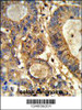 Formalin-fixed and paraffin-embedded human colon carcinoma reacted with GUSB Antibody, which was peroxidase-conjugated to the secondary antibody, followed by DAB staining.