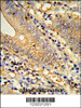 Formalin-fixed and paraffin-embedded human colon carcinoma reacted with TSPAN33 Antibody, which was peroxidase-conjugated to the secondary antibody, followed by DAB staining.