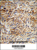 Formalin-fixed and paraffin-embedded human lung carcinoma reacted with AGR3 Antibody, which was peroxidase-conjugated to the secondary antibody, followed by DAB staining.