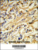Formalin-fixed and paraffin-embedded human breast carcinoma reacted with CHMP4B Antibody (N-term) , which was peroxidase-conjugated to the secondary antibody, followed by DAB staining.