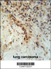 DCLRE1C Antibody immunohistochemistry analysis in formalin fixed and paraffin embedded human lung carcinoma followed by peroxidase conjugation of the secondary antibody and DAB staining.