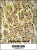 NDUFS2 Antibody IHC analysis in formalin fixed and paraffin embedded hepatocarcinoma followed by peroxidase conjugation of the secondary antibody and DAB staining.