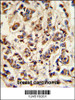 ATP6V1A Antibody IHC analysis in formalin fixed and paraffin embedded breast carcinoma followed by peroxidase conjugation of the secondary antibody and DAB staining.