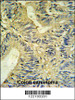 LXN Antibody IHC analysis in formalin fixed and paraffin embedded colon carcinoma followed by peroxidase conjugation of the secondary antibody and DAB staining.