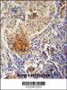 TYROBP Antibody immunohistochemistry analysis in formalin fixed and paraffin embedded human lung carcinoma followed by peroxidase conjugation of the secondary antibody and DAB staining.