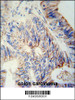 B3GNT6 Antibody immunohistochemistry analysis in formalin fixed and paraffin embedded human colon carcinoma followed by peroxidase conjugation of the secondary antibody and DAB staining.