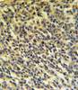 PLA2G6 Antibody IHC analysis in formalin fixed and paraffin embedded testis carcinoma followed by peroxidase conjugation of the secondary antibody and DAB staining.