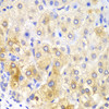 Immunohistochemistry of paraffin-embedded human liver cancer using Fatty Acid Synthase Antibody (13-177) at dilution of 1:100 (40x lens) .