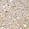 Immunohistochemistry of paraffin-embedded human brain cancer using CDK6 antibody (13-257) at dilution of 1:100 (40x lens) .
