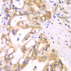 Immunohistochemistry of paraffin-embedded human liver cancer using ACADS antibody (13-328) at dilution of 1:100 (40x lens) .