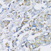 Immunohistochemistry of paraffin-embedded human breast cancer using Hexokinase II antibody (13-360) at dilution of 1:200 (40x lens) .