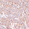 Immunohistochemistry of paraffin-embedded human liver cancer using YAP1 antibody (13-370) at dilution of 1:100 (40x lens) .