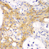 Immunohistochemistry of paraffin-embedded human oophoroma using alpha smooth muscle actin antibody (13-434) at dilution of 1:100 (40x lens) .