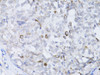 Immunohistochemistry of paraffin-embedded human breast cancer using BRCA1 antibody (14-048) at dilution of 1:100 (40x lens) .