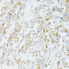 Immunohistochemistry of paraffin-embedded human lung cancer using EGFR antibody (14-053) at dilution of 1:100 (40x lens) .