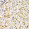 Immunohistochemistry of paraffin-embedded human liver cancer using ACTN1 antibody (14-062) at dilution of 1:100 (40x lens) .