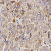 Immunohistochemistry of paraffin-embedded human liver cancer using GAS2 antibody (14-097) at dilution of 1:200 (40x lens) .