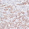 Immunohistochemistry of paraffin-embedded human liver cancer using TGFBR2 antibody (14-143) at dilution of 1:100 (40x lens) .