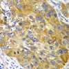 Immunohistochemistry of paraffin-embedded human esophageal cancer using AK1 antibody (14-299) at dilution of 1:100 (40x lens) .
