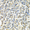 Immunohistochemistry of paraffin-embedded human lung cancer using ADSS antibody (14-399) at dilution of 1:100 (40x lens) .