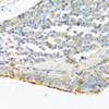 Immunohistochemistry of paraffin-embedded human lung cancer using PRSS1 antibody (14-411) at dilution of 1:100 (40x lens) .