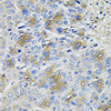 Immunohistochemistry of paraffin-embedded human liver cancer using SERPINA1 antibody (14-451) at dilution of 1:100 (40x lens) .