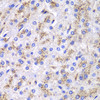 Immunohistochemistry of paraffin-embedded human liver cancer using CTSD antibody (14-893) at dilution of 1:100 (40x lens) .