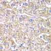 Immunohistochemistry of paraffin-embedded human liver damage using DLST antibody (14-898) at dilution of 1:100 (40x lens) .