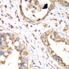 Immunohistochemistry of paraffin-embedded human liver cancer using HADHA antibody (14-909) at dilution of 1:100 (40x lens) .